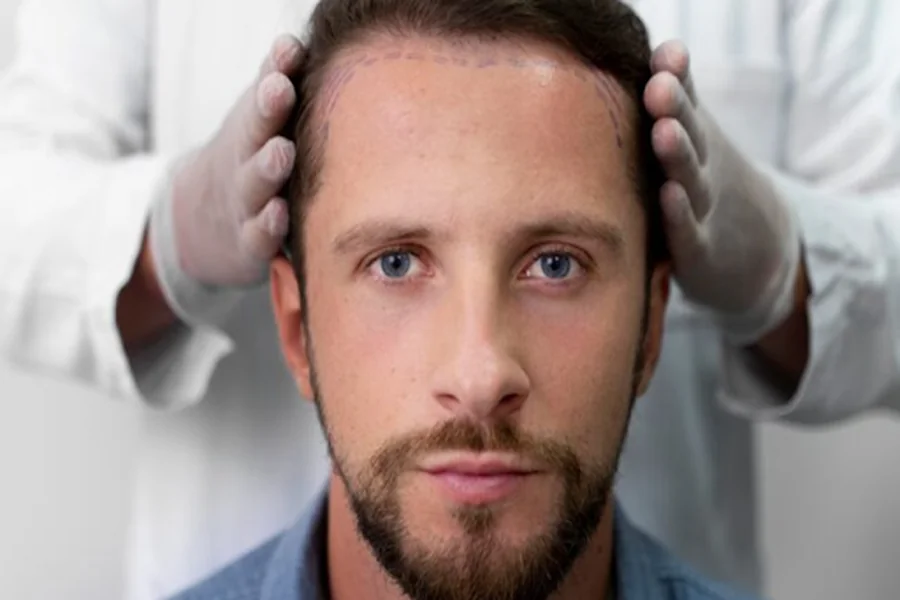 Hair Transplant